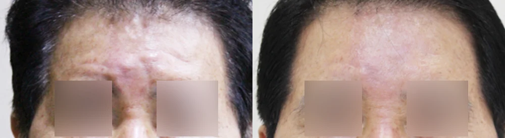 Under-Eye, Glabella and Nose Filler Removal in Seoul: How Far Can Removal Safely Go? · Before and after 2