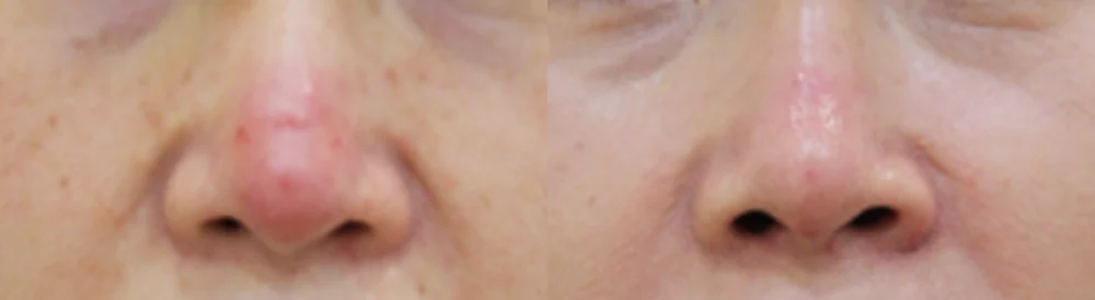 Under-Eye, Glabella and Nose Filler Removal in Seoul: How Far Can Removal Safely Go? · Before and after 4