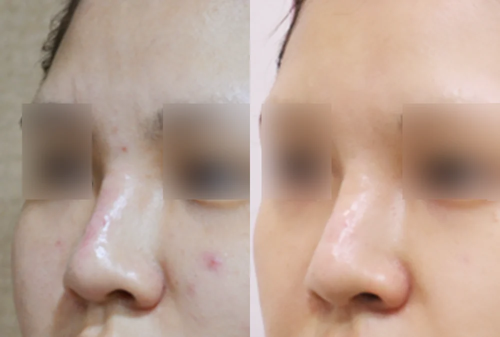 눈·미간·코 성형 부작용 재건 시술 전후 사진 8 · 보니따의원