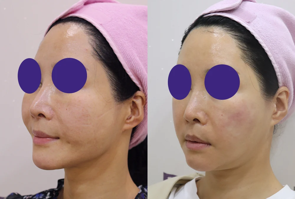 눈·미간·코 성형 부작용 재건 시술 전후 사진 13 · 보니따의원