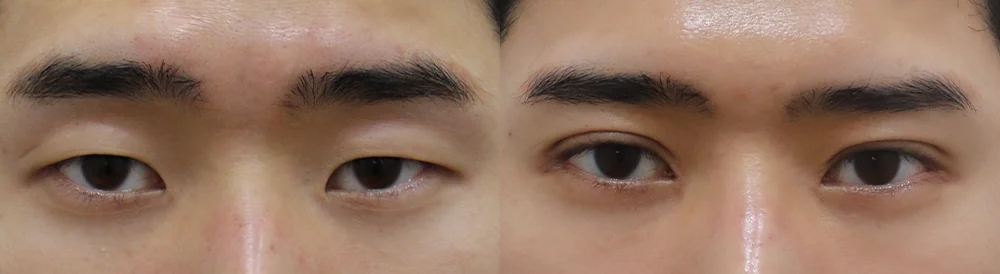 눈 성형 시술 전후 사진 4 · 보니따의원