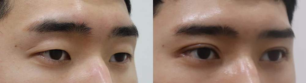 눈 성형 시술 전후 사진 5 · 보니따의원