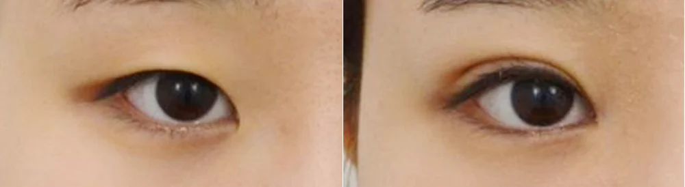 눈 성형 시술 전후 사진 12 · 보니따의원