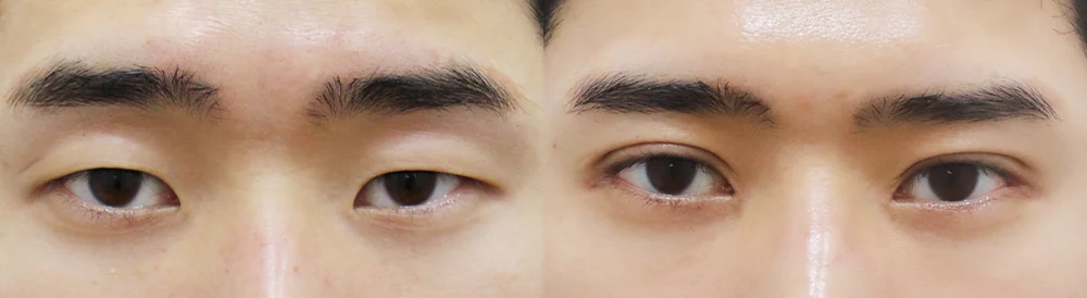 눈 성형 시술 전후 사진 20 · 보니따의원