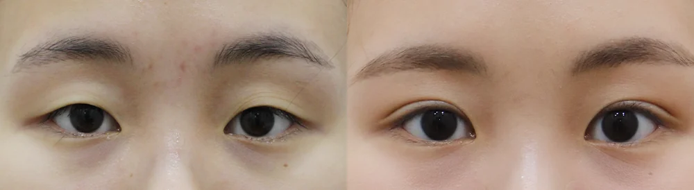 눈 성형 시술 전후 사진 22 · 보니따의원