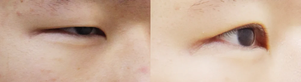 눈 성형 시술 전후 사진 27 · 보니따의원