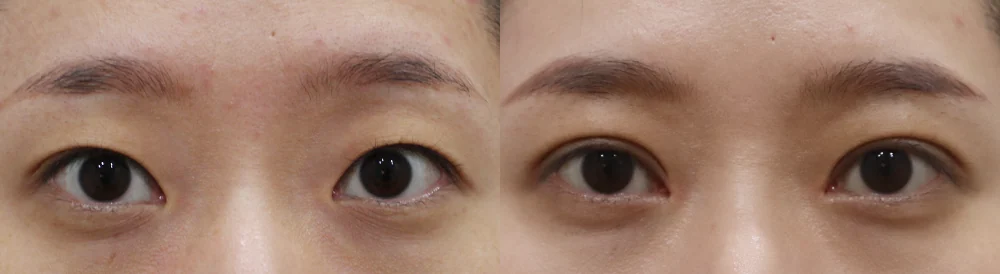 눈 성형 시술 전후 사진 29 · 보니따의원
