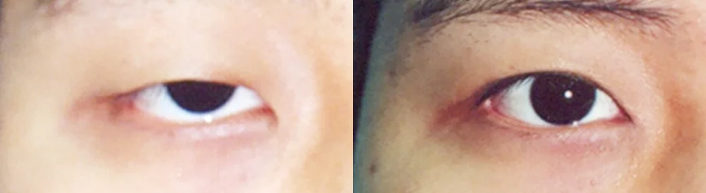 눈 성형 시술 전후 사진 34 · 보니따의원