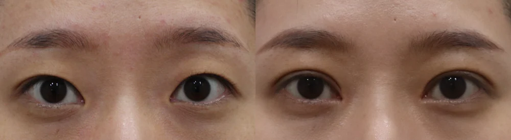 눈 성형 시술 전후 사진 41 · 보니따의원