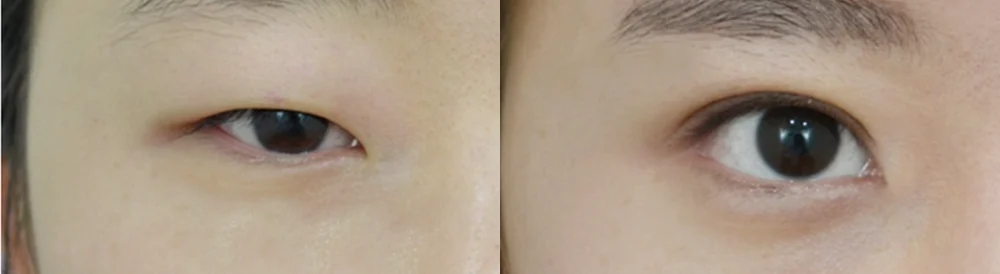 눈 성형 시술 전후 사진 44 · 보니따의원