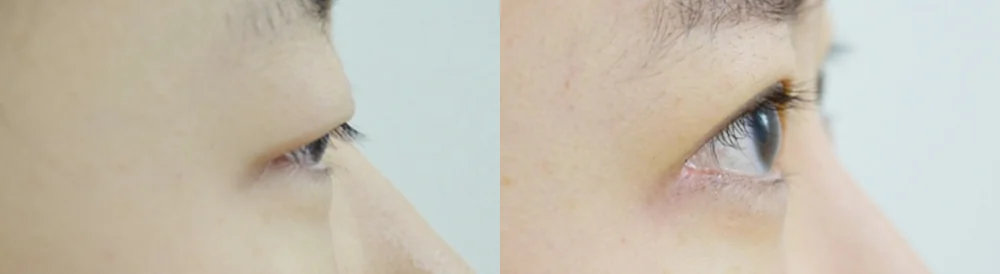 눈 성형 시술 전후 사진 45 · 보니따의원