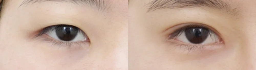 눈 성형 시술 전후 사진 46 · 보니따의원