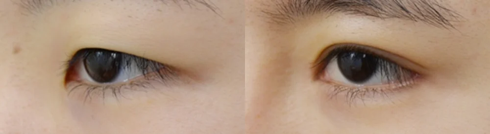 눈 성형 시술 전후 사진 47 · 보니따의원