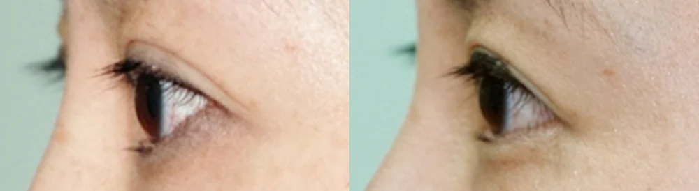 눈 성형 시술 전후 사진 49 · 보니따의원