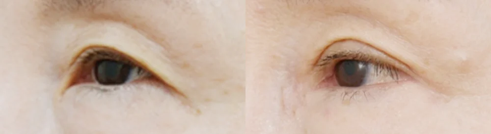 눈 성형 시술 전후 사진 51 · 보니따의원