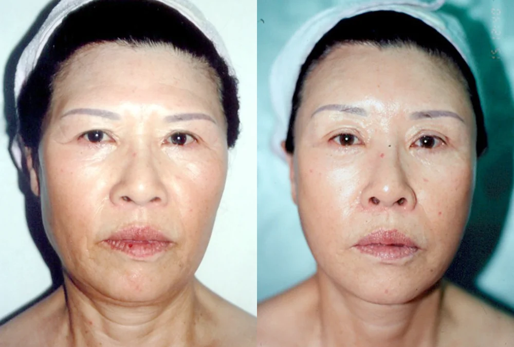 안면거상술, 어떤 처짐에 필요하고 회복은 어떨까요? · 전후 사진 3