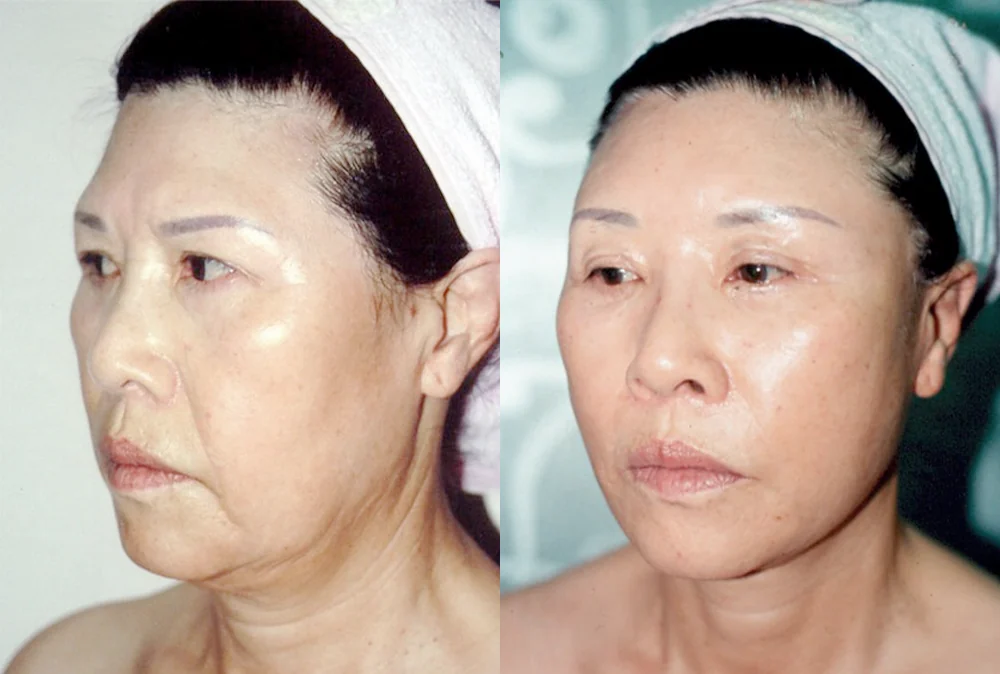안면거상술, 어떤 처짐에 필요하고 회복은 어떨까요? · 전후 사진 2