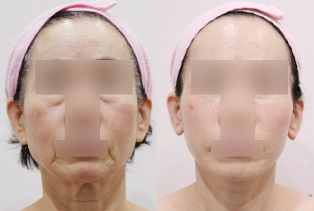 안면거상술 시술 전후 사진 10 · 보니따의원