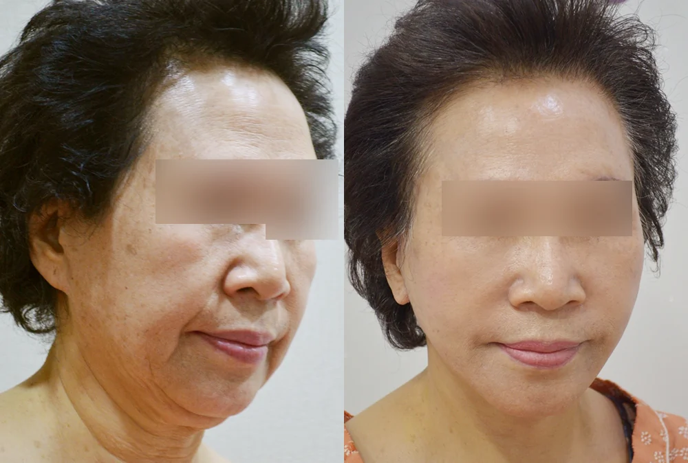 안면거상술 시술 전후 사진 15 · 보니따의원