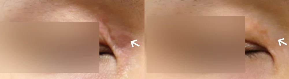 Face 패인·절개 흉터 시술 전후 사진 5 · 보니따의원