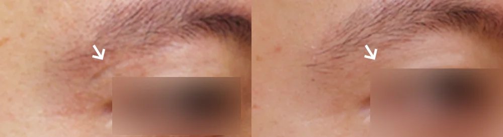 Face 패인·절개 흉터 시술 전후 사진 7 · 보니따의원