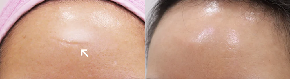 사고·수술로 얼굴에 패인 흉터, 무엇으로 올릴 수 있을까요? · 전후 사진 1