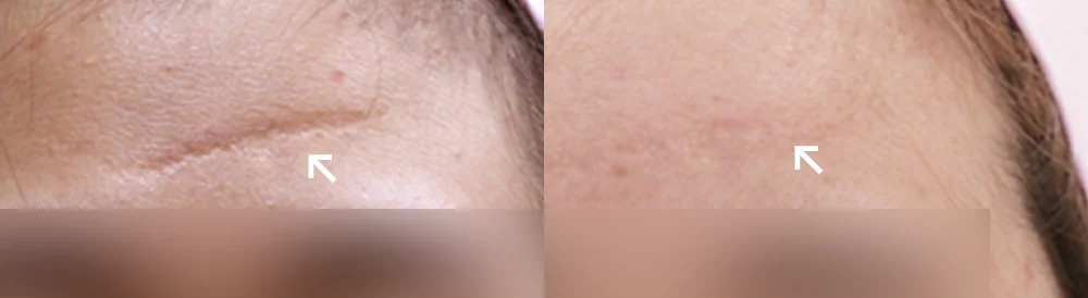 수술 흉터, 언제부터 치료를 상담하면 좋을까요? · 전후 사진 3