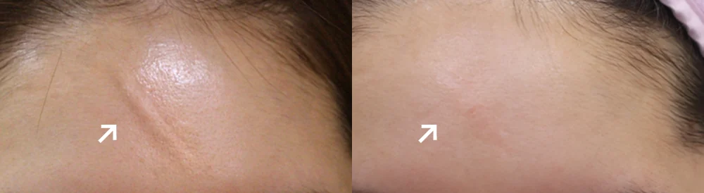 수술 흉터, 언제부터 치료를 상담하면 좋을까요? · 전후 사진 4