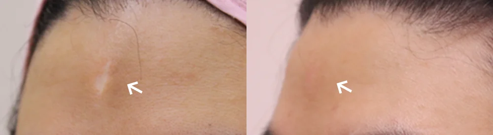 사고·수술로 얼굴에 패인 흉터, 무엇으로 올릴 수 있을까요? · 전후 사진 2