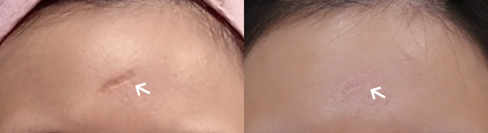 Face 패인·절개 흉터 시술 전후 사진 16 · 보니따의원