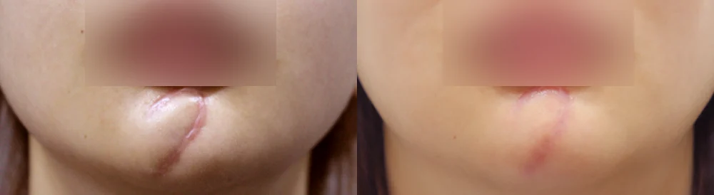 사고·수술로 얼굴에 패인 흉터, 무엇으로 올릴 수 있을까요? · 전후 사진 3