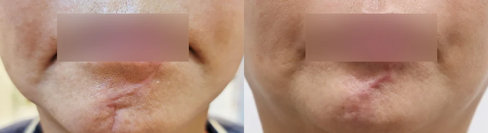 사고·수술로 얼굴에 패인 흉터, 무엇으로 올릴 수 있을까요? · 전후 사진 4