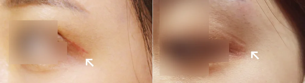 Face 성형 흉터 시술 전후 사진 3 · 보니따의원