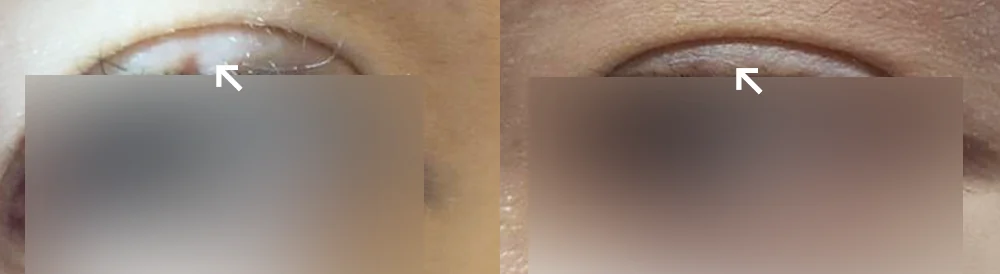 Face 성형 흉터 시술 전후 사진 4 · 보니따의원