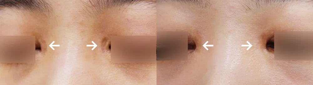 Face 성형 흉터 시술 전후 사진 1 · 보니따의원