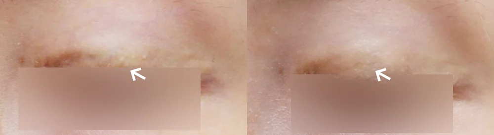 수술 흉터, 언제부터 치료를 상담하면 좋을까요? · 전후 사진 1