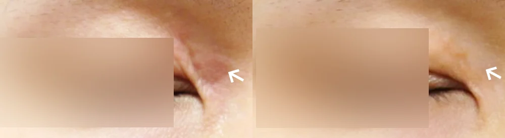 수술 흉터, 언제부터 치료를 상담하면 좋을까요? · 전후 사진 2