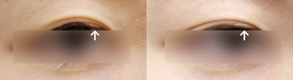 Face 성형 흉터 시술 전후 사진 6 · 보니따의원