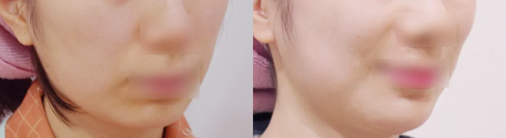 돌출입 지방이식 시술 전후 사진 6 · 보니따의원