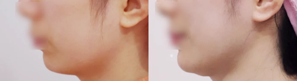 돌출입, 지방이식으로 어디까지 달라질 수 있을까요? · 전후 사진 2