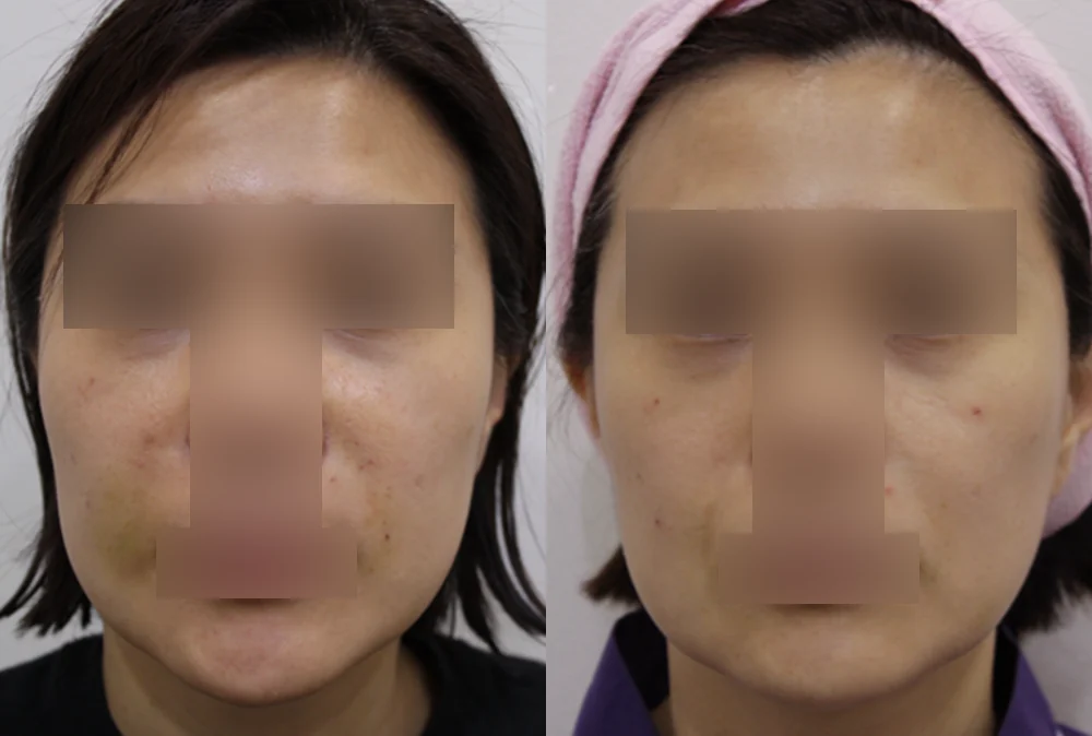 이마·턱·볼 성형 부작용 재건 시술 전후 사진 4 · 보니따의원