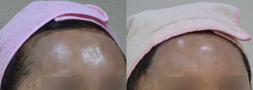 이마·턱·볼의 필러와 이물질, 빼고 나면 꺼지지 않을까요? · 전후 사진 1