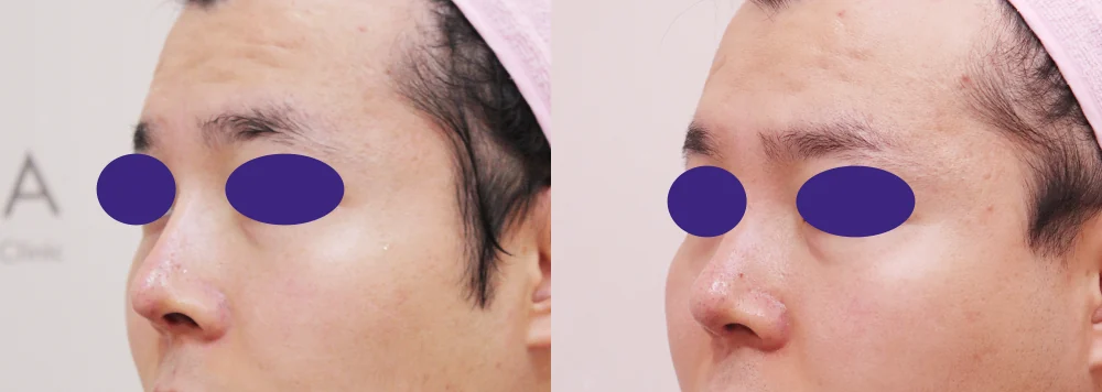 구순열 코 성형 (언청이 코 재건) 시술 전후 사진 2 · 보니따의원