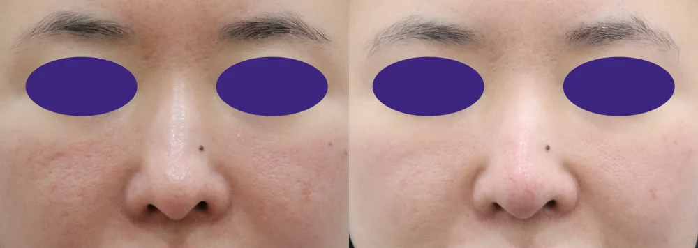 전체 코 수술, 콧대 재료와 코끝 받침은 어떻게 정할까요? · 전후 사진 2