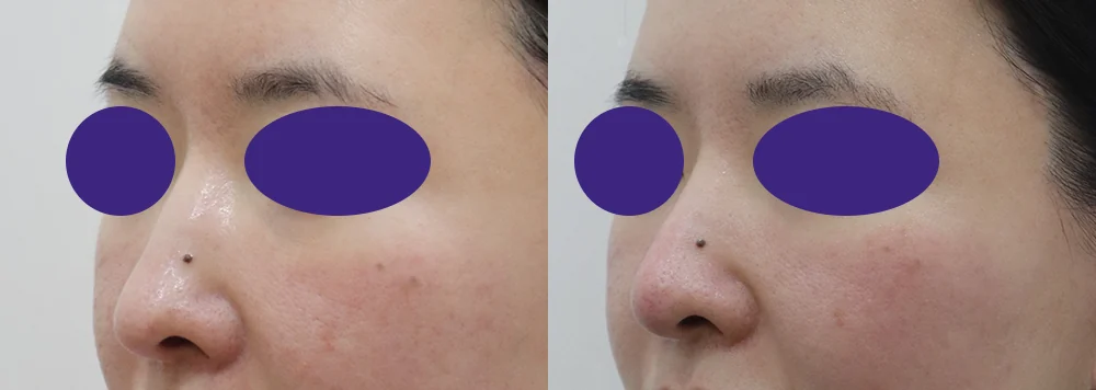 Flying After Rhinoplasty in Seoul: How Soon Can You Fly Home? · Before and after 3