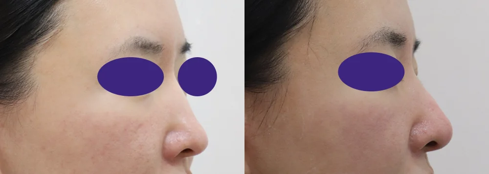 Flying After Rhinoplasty in Seoul: How Soon Can You Fly Home? · Before and after 1