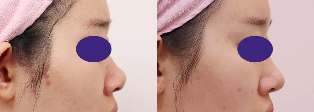 Flying After Rhinoplasty in Seoul: How Soon Can You Fly Home? · Before and after 2