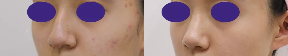 전체 코 수술 시술 전후 사진 20 · 보니따의원