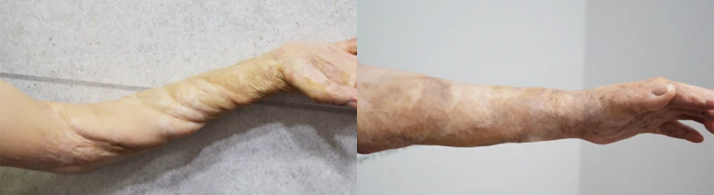 다치거나 화상을 입은 직후, 흉터를 줄이려면 무엇을 해야 할까요? · 전후 사진 2