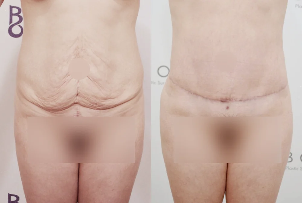 체형성형센터 시술 전후 사진 2 · 보니따의원